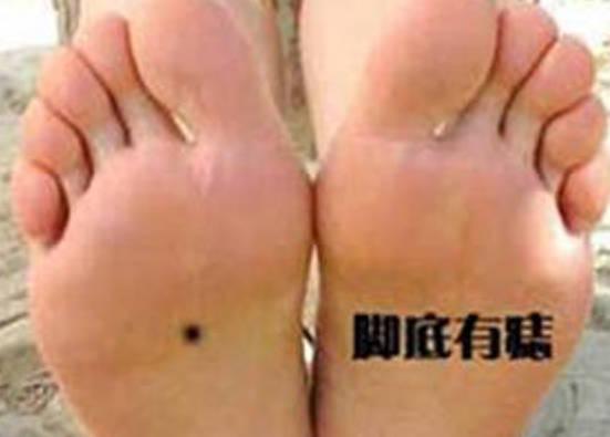 女人脚底长痣代表什么，代表有权有势 1