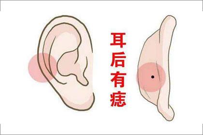 耳朵后面有痣代表什么 怎么解释 2