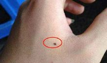 手上长痣长在手眼部位好不好呢