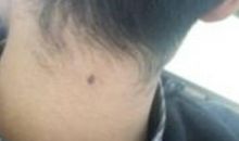 苦情痣在哪个位置，苦情痣在脖子后方