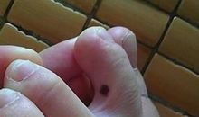 男人脚趾有痣代表什么，脚拇指和指缝间表富贵