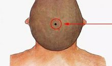 身上六大好运痣，男成龙，女成凤，坐拥有万贯家财！ 