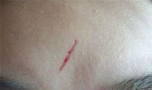 身上这五个部位最忌讳有疤！