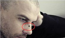 注意!男人长有这些痣容易出轨!