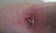 梦见流脓脓包意味着什么