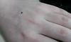 手背不同位置的痣图解痣相
