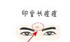 印堂上长痘代表着什么呢