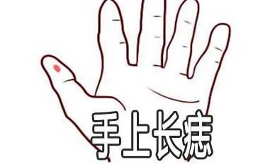 手上长痣是什么意思 有好运吗