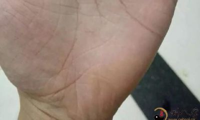 看手知健康，有病早预防，乳腺癌手纹长啥样，如何自我手诊和调理