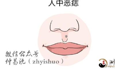 痣相：人中有痣，看着你运程吉凶祸福