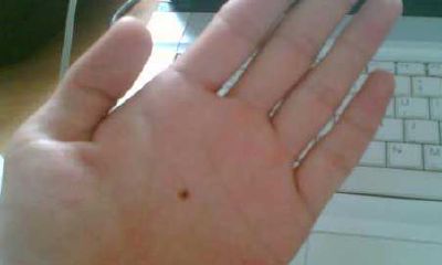 手掌心痣相之解读