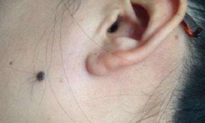 痣上长毛有福是真的吗