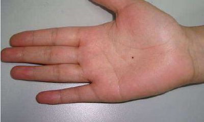 手掌有痣代表什么寓意？手掌有痣好不好？