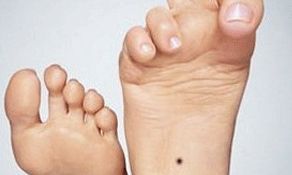 脚底有痣好不好，脚底长痣代表什么？