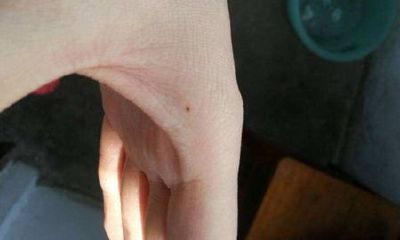 左手虎口有痣，右手虎口有痣，虎口有痣图解