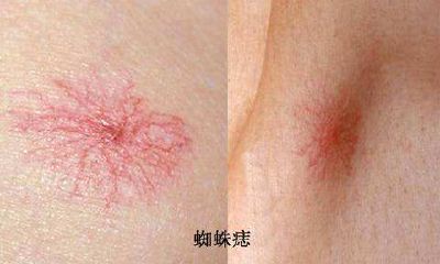 蜘蛛痣图片，蜘蛛痣是什么？