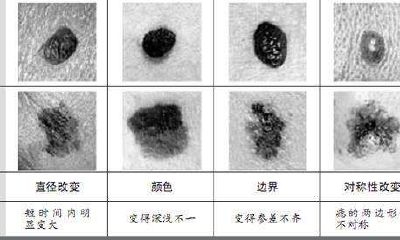 黑色素细胞痣，黑色素痣图