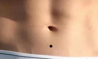 富贵痣！肚脐有痣、腋下有痣、下巴有痣，好还是不好？