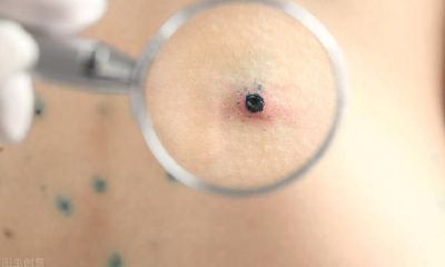 小心，容易癌变的痣长成这样！早期4个信号你要知道