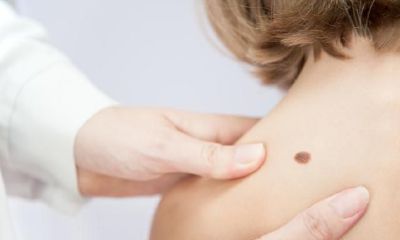 身上的痣是分几种？有好坏之分