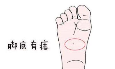 脚上有痣代表什么？脚上有痣好不好？