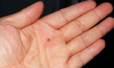 手上有痦子代表什么，手上痦子的位置与命运