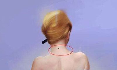 苦情痣与命运，脖子后面有痣怎么办？