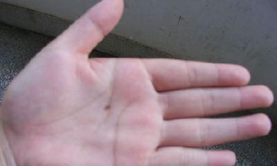 手上长痣面相图，手心长痣好不好？