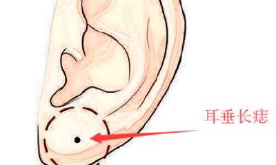 旺财痣, 身上此处长善痣, 发横财, 进偏财, 看你脸上得是不是