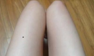 女人大腿上长痣好吗