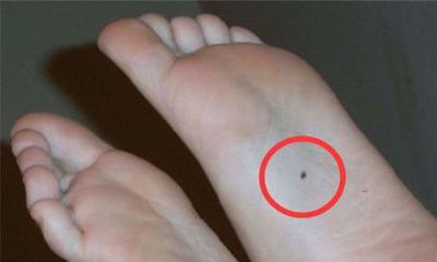 脚底有痣的人多吗