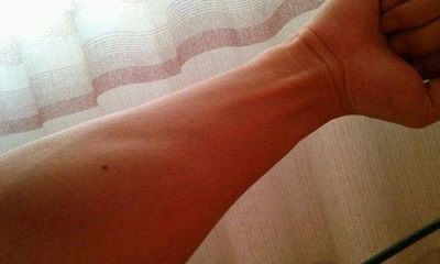 手臂痣上长毛命运如何 手臂痣代表什么