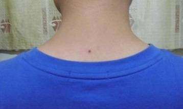 男人脖子后面长痣代表什么