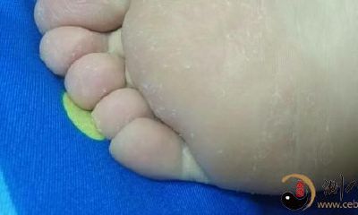 梦见脚脱了一层皮