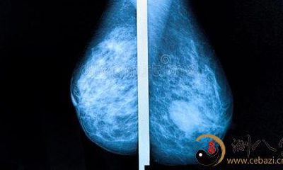 梦到自己胸脯长了一个痞瘩