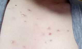 梦到全身上下起疙瘩