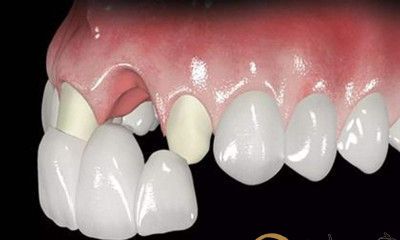 梦到自己牙齿掉落