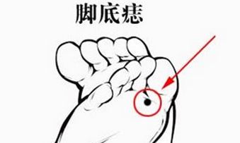 男生右脚脚底有痣代表着什么