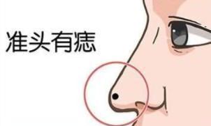 鼻子周围有痣好不好，鼻子上的痣看你是否富贵命