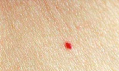 身上长红痣是怎么回事？
