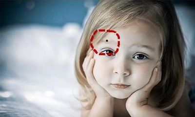 小孩子这三个地方长痣，长大后必定出人头地