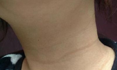 痣相分析咽喉有痣预示的含义