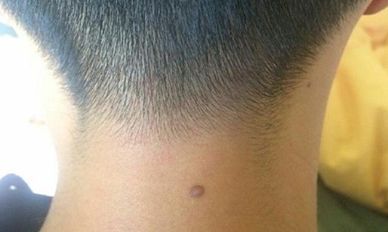 男人脖子后边痣相与感情