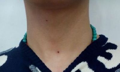 男人脖子前面有痣代表什么