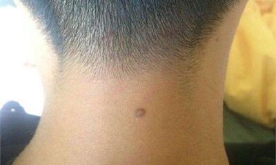 男人脖子上有痣代表什么