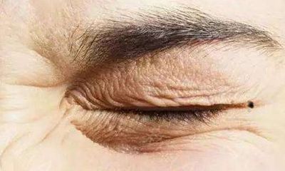 眼角的活痣代表什么