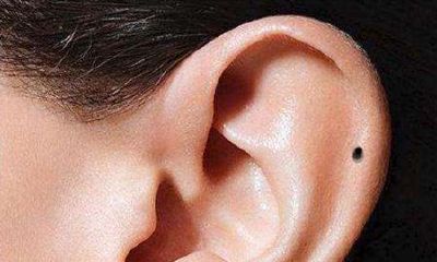 耳朵的活痣代表什么