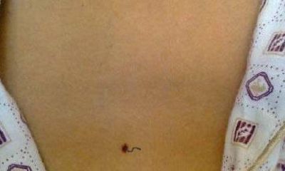 胸前痣长毛有什么说法