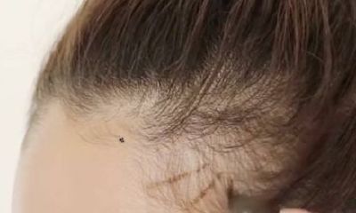 发际线上有痣命运如何