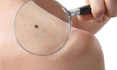 什么是「苦海痣」？有「苦海痣」的人命好不好